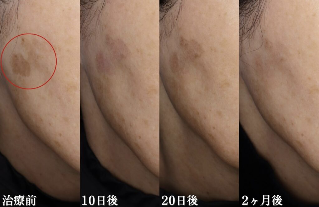 シミ取りをする上で知っておいて欲しいこと | 長野県松本市 丸の内美容  